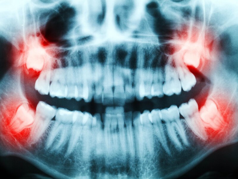 Stem Cells from Wisdom Teeth May Naturally Regenerate Heart, Bone, and Brain Tissue, Study Finds