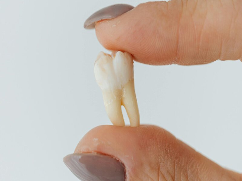 Wisdom Teeth: A Hidden Source of Life-Saving Stem Cells, Scientists Reveal