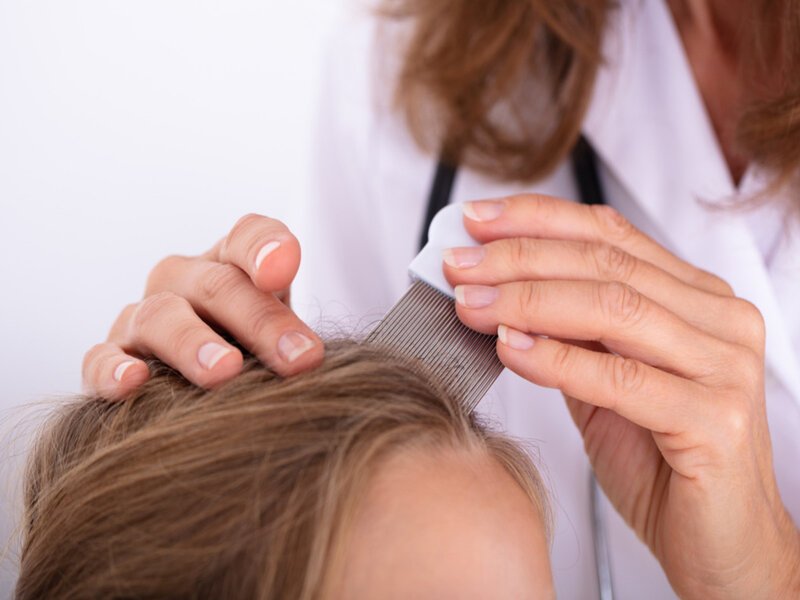 Can Lice Kill? Girl Dies After Severe Head Lice Infestation Leads to Fatal Infection