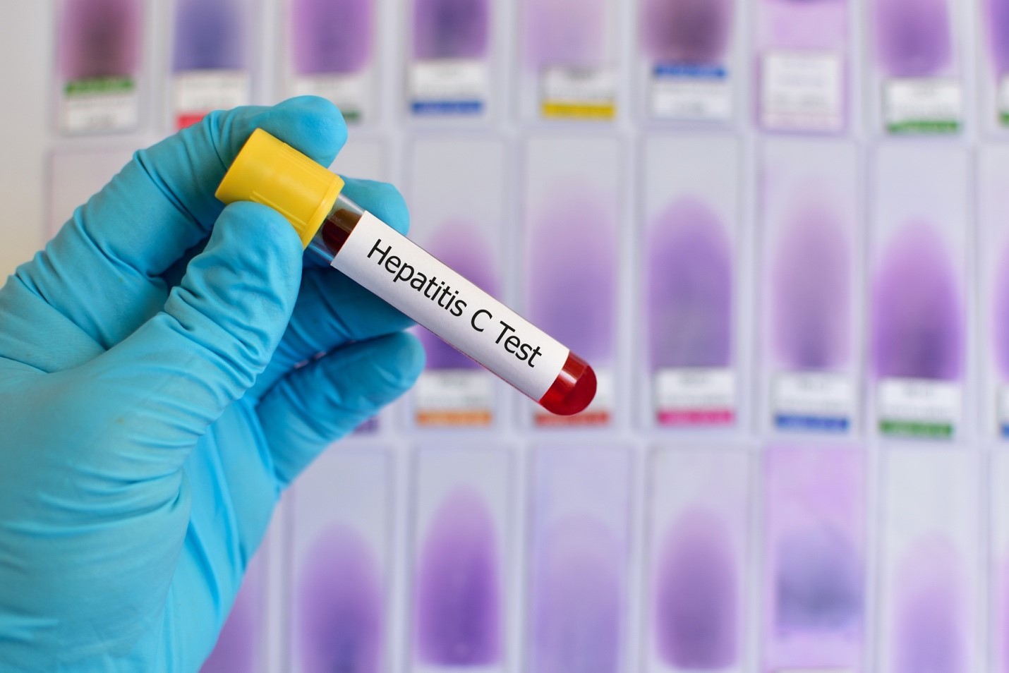 Hepatitis C Cases Pakistan
